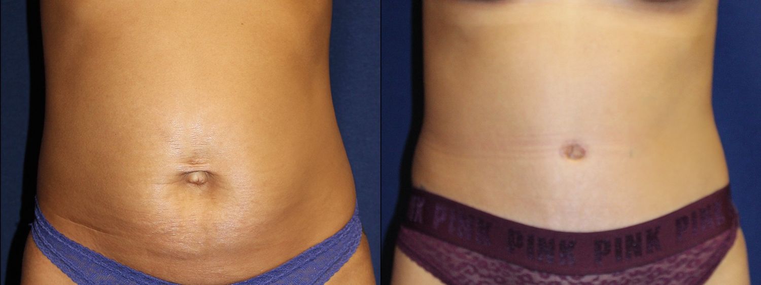 Tummy Tuck Before & After