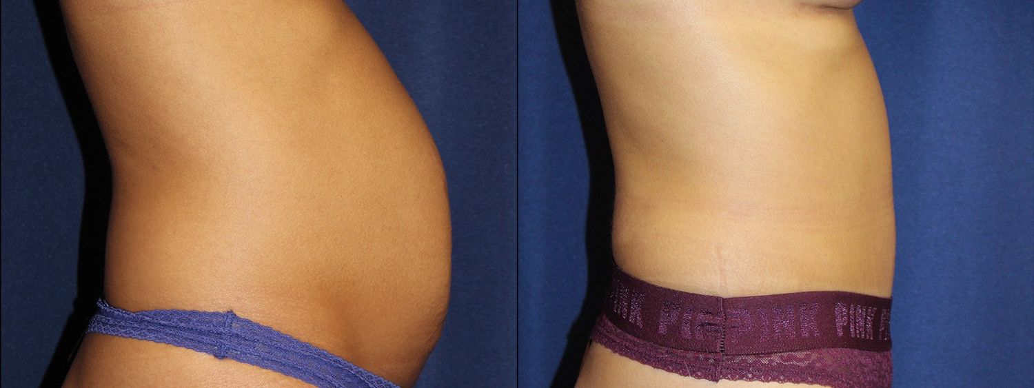 Tummy Tuck Before & After