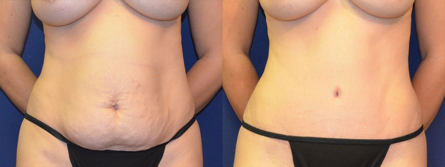 Tummy Tuck Before & After