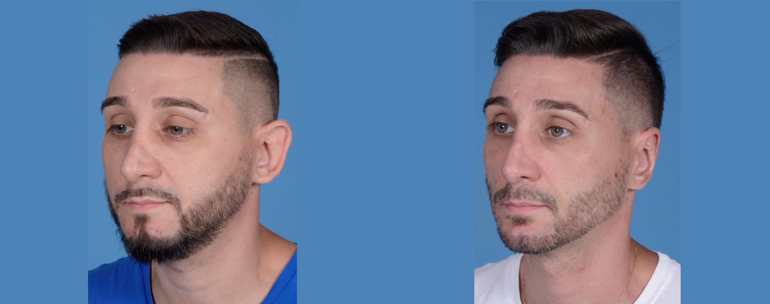 Rhinoplasty Before & After