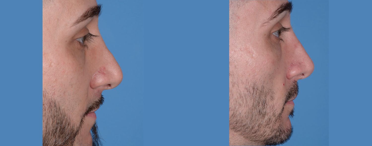 Rhinoplasty Before & After