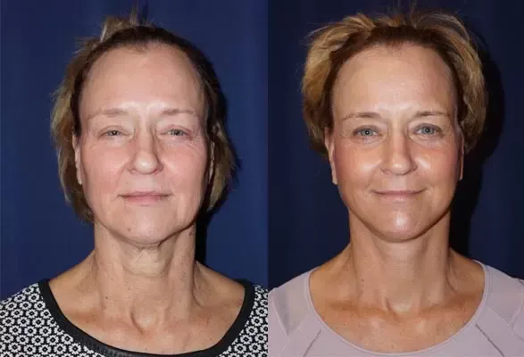 Facelift Before & After