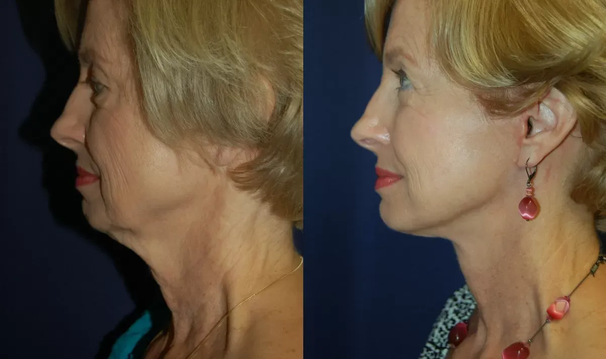 Facelift Before & After