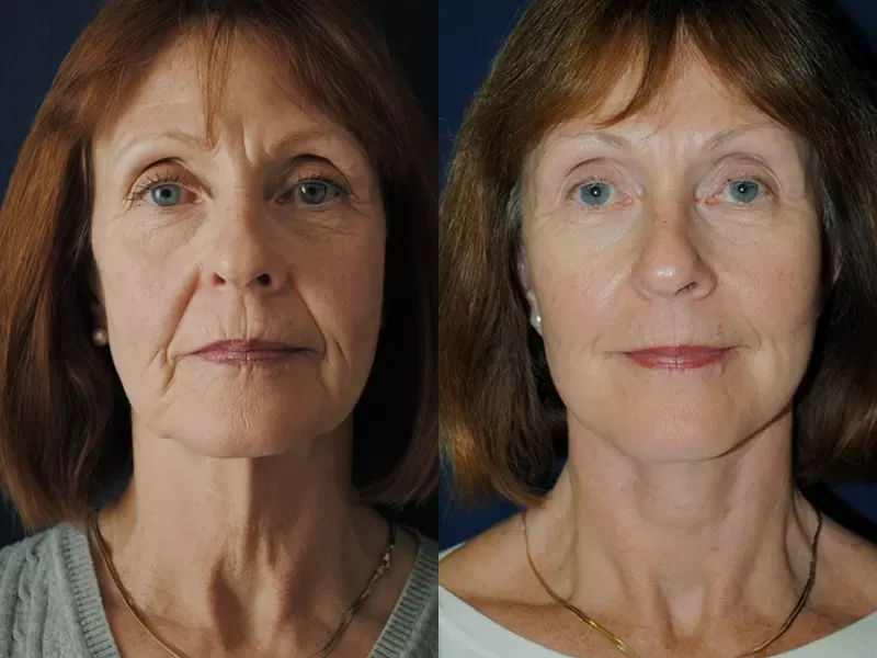 Facelift Before & After