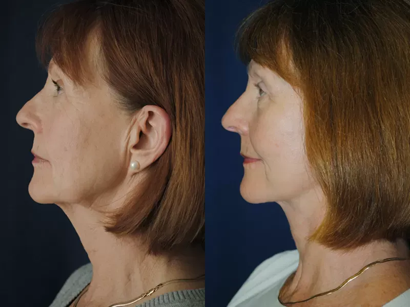 Facelift Before & After