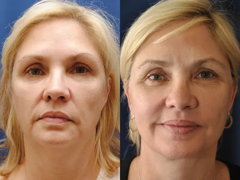 Facelift Before & After