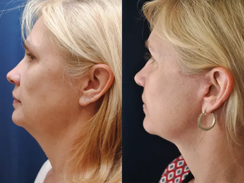 Facelift Before & After