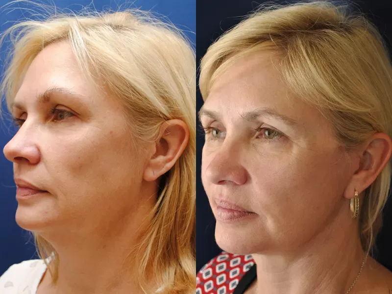 Facelift Before & After
