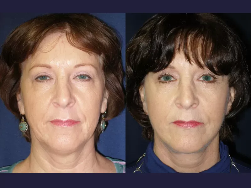 Facelift Before & After