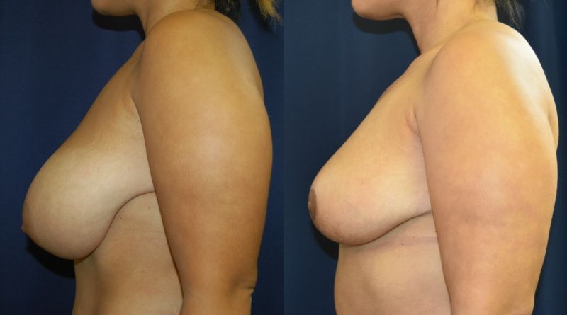 Breast Reduction Before & After