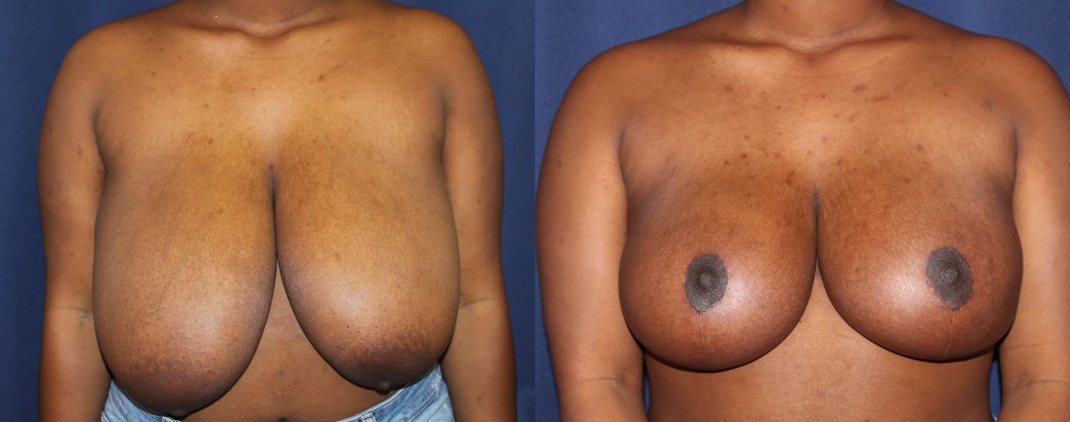 Breast Reduction Before & After