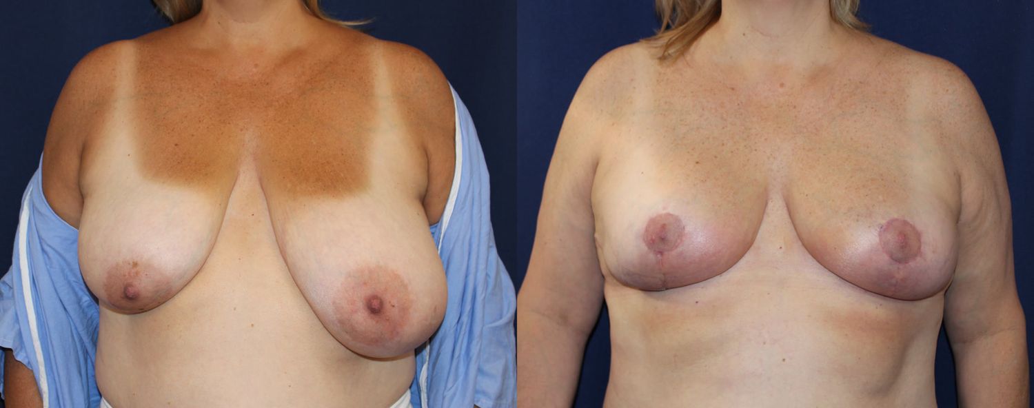 Breast Reduction Before & After