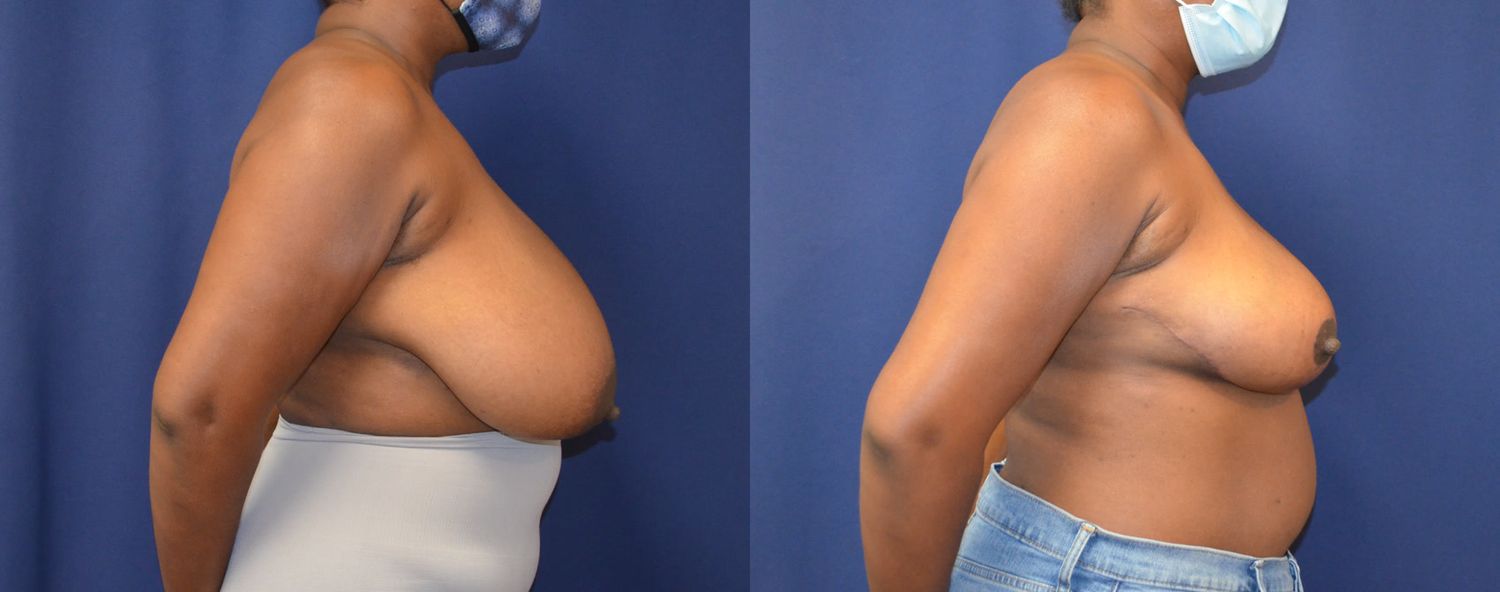 Breast Reduction Before & After