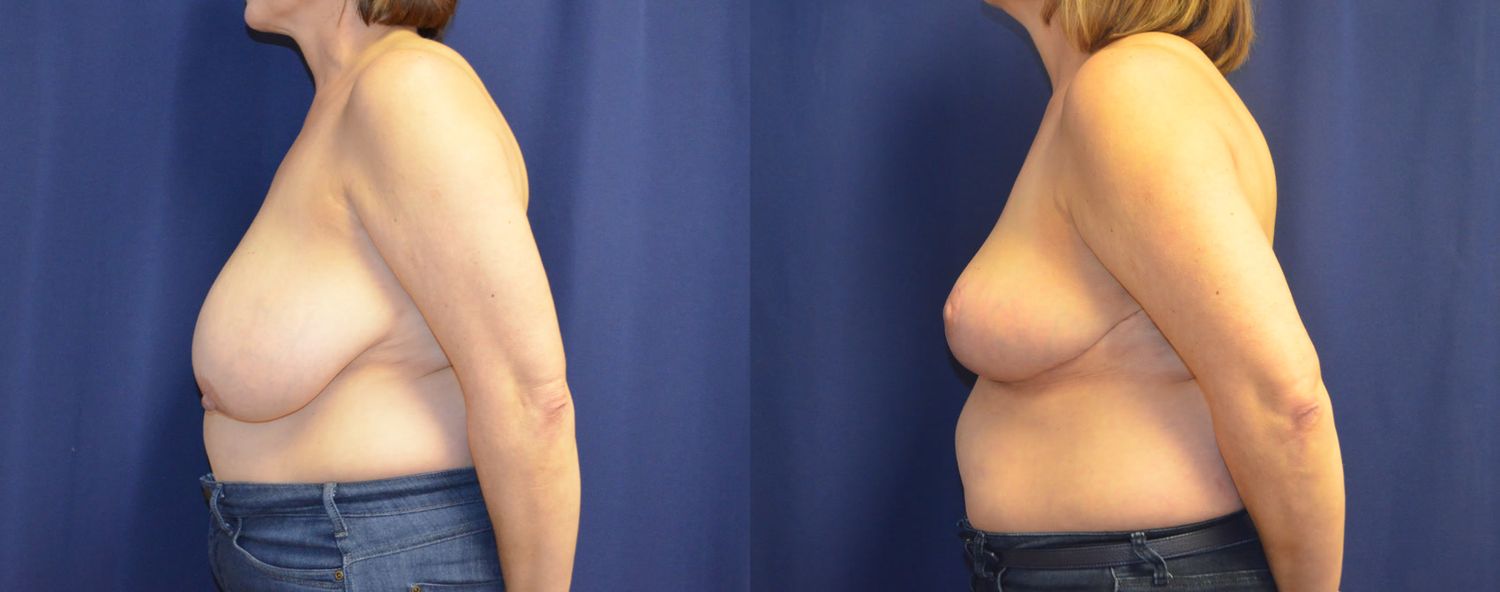 Breast Reduction Before & After