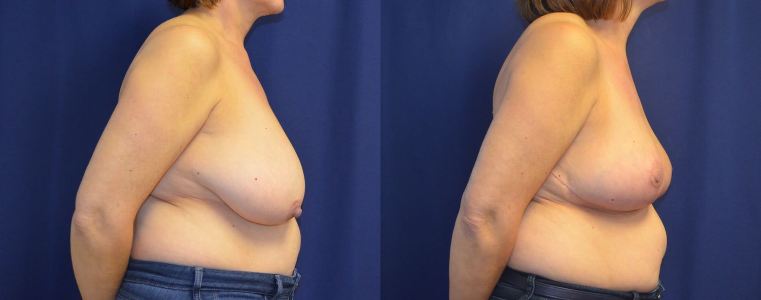 Breast Reduction Before & After