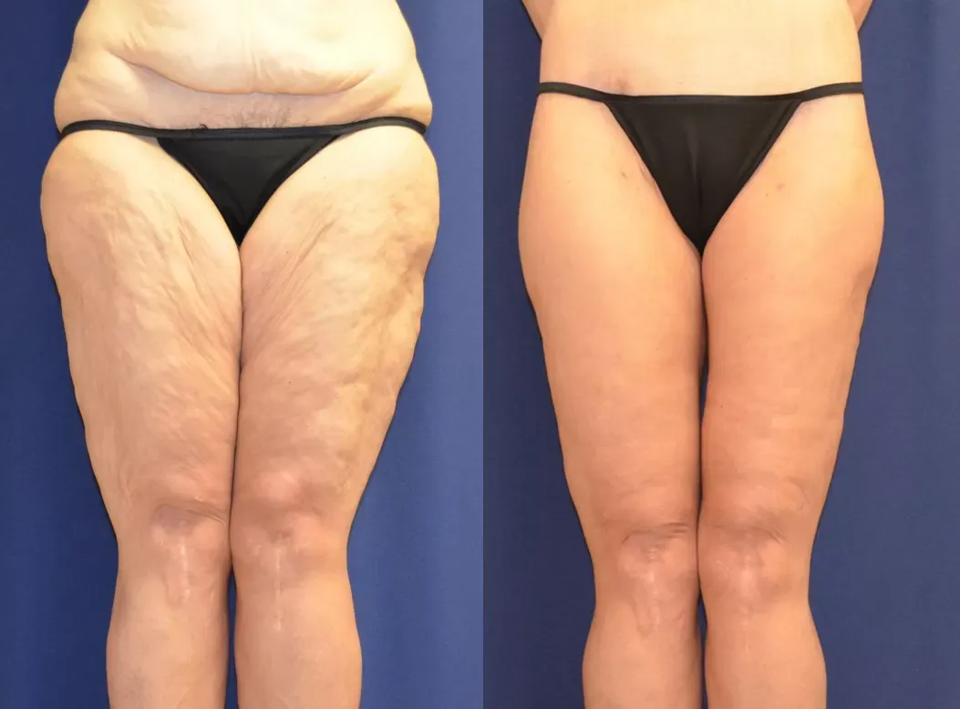 Liposuction Before & After