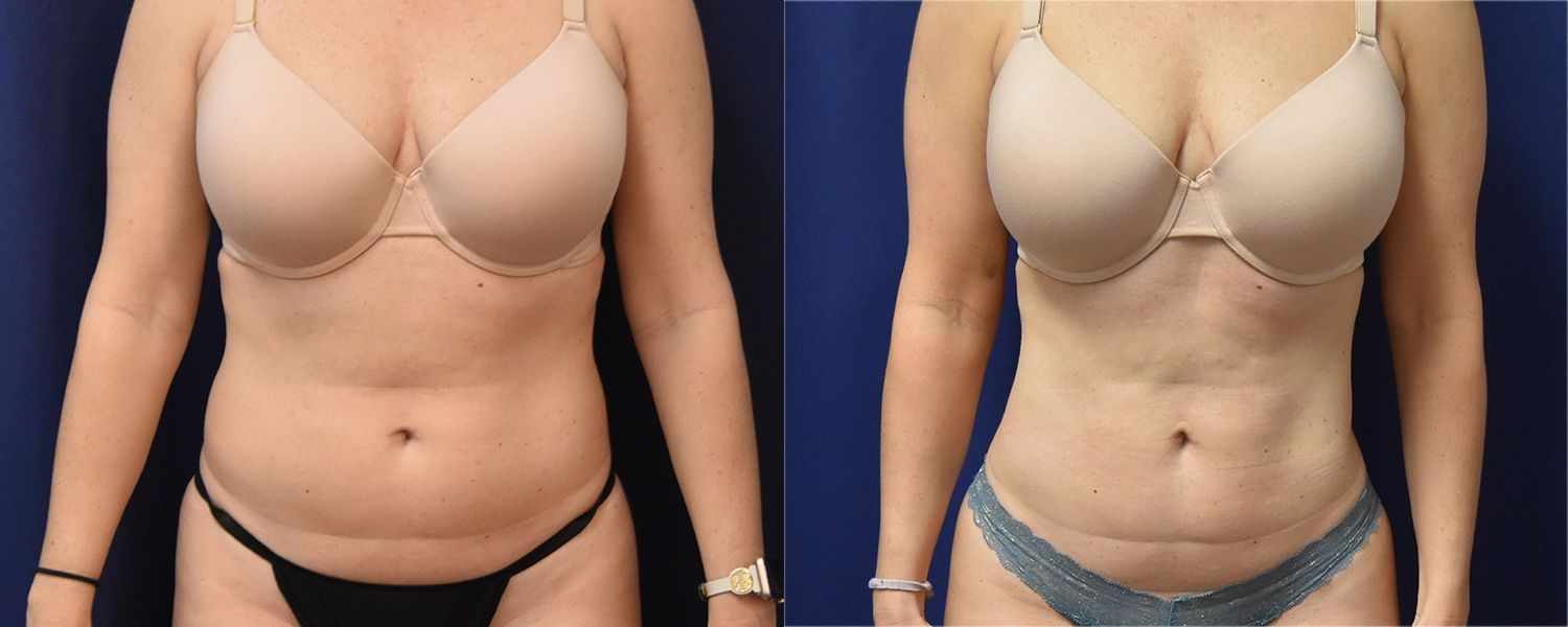 Liposuction Before & After