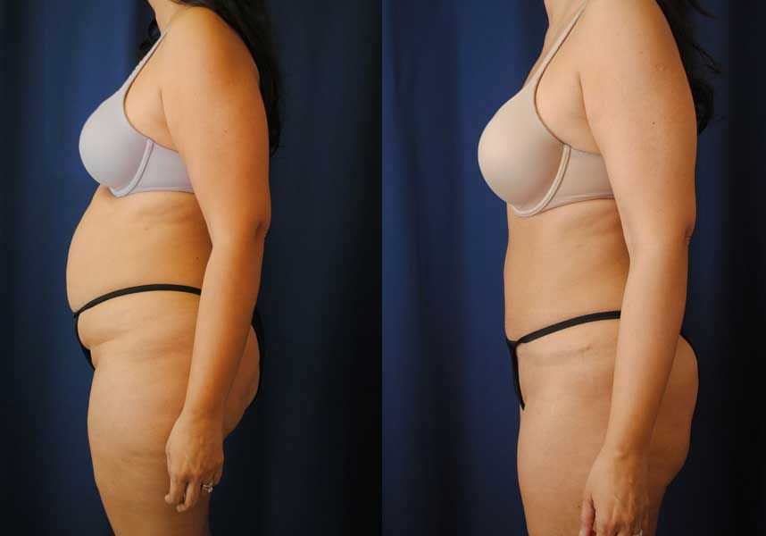 Liposuction Before & After