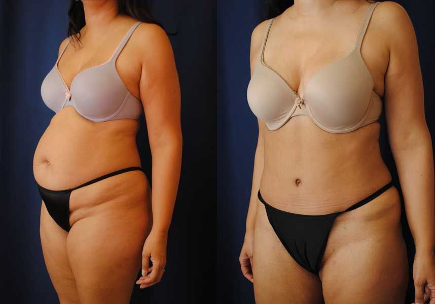 Liposuction Before & After