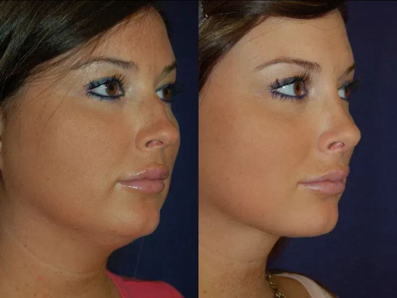 Liposuction Before & After