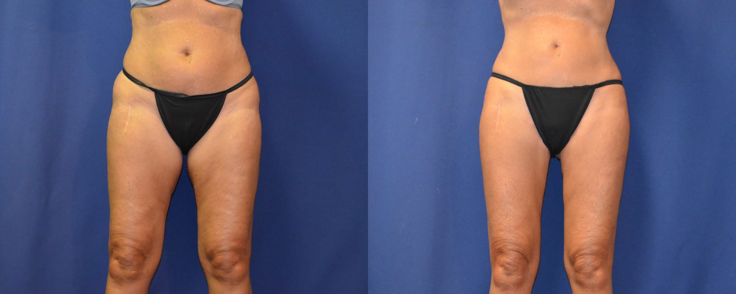 Liposuction Before & After