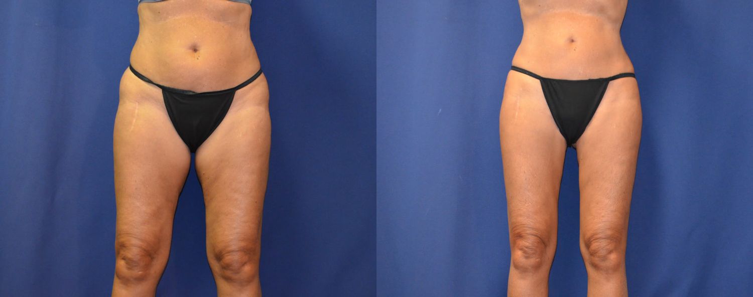 Liposuction Before & After