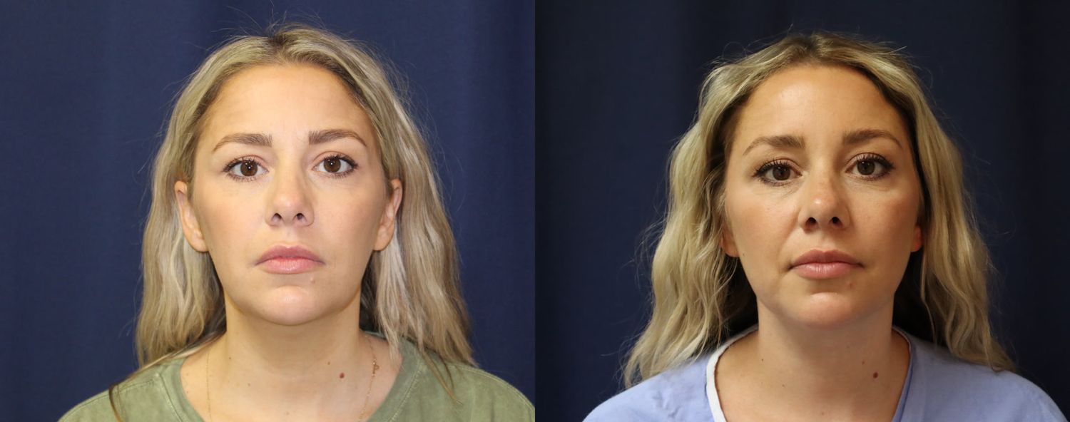 Liposuction Before & After