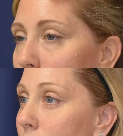 Eyelid Surgery Before & After