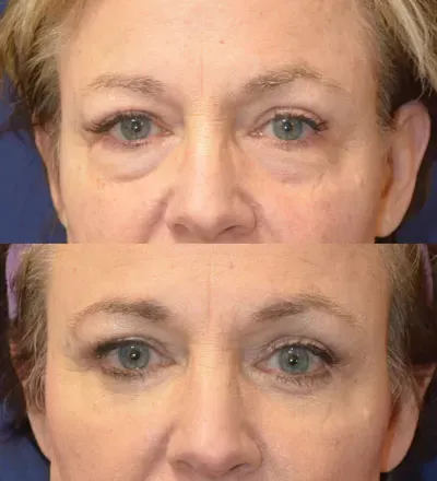 Eyelid Surgery Before & After