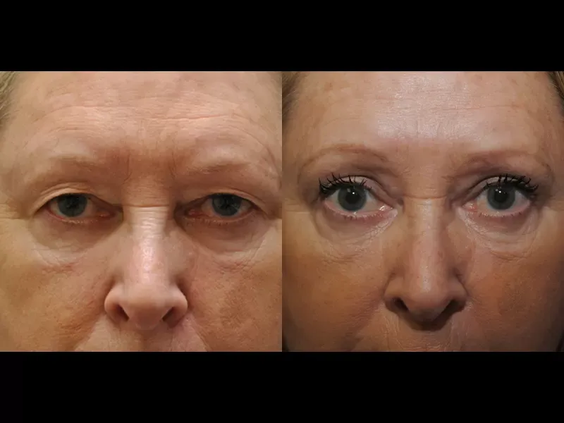 Eyelid Surgery Before & After