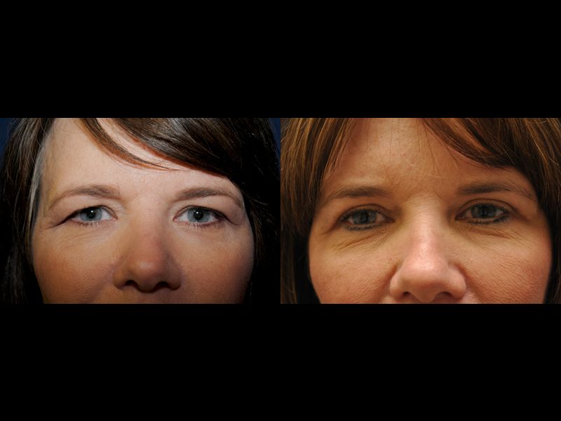 Eyelid Surgery Before & After