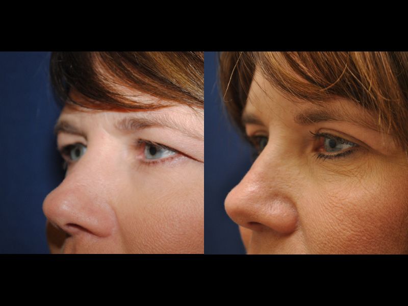 Eyelid Surgery Before & After