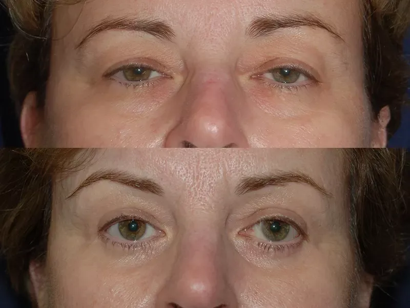 Eyelid Surgery Before & After