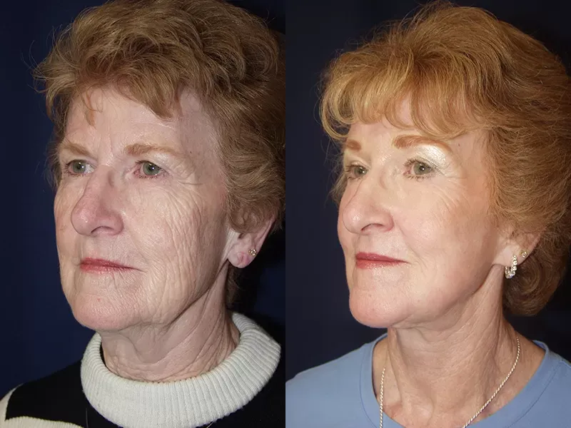 Eyelid Surgery Before & After