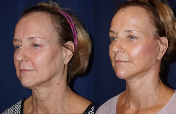 Facial Skin Rejuvenation Before & After