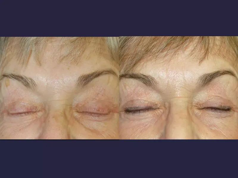 Facial Skin Rejuvenation Before & After