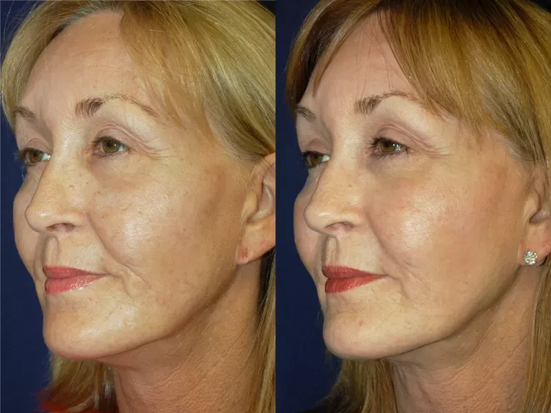 Facial Skin Rejuvenation Before & After