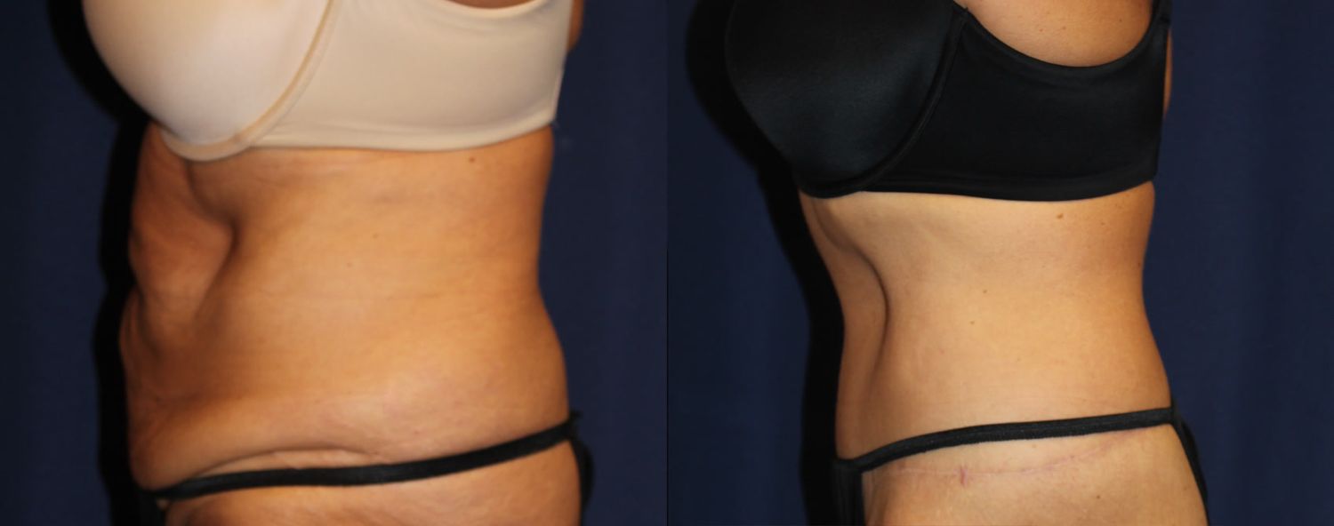 Circumferential Abdominoplasty Before & After