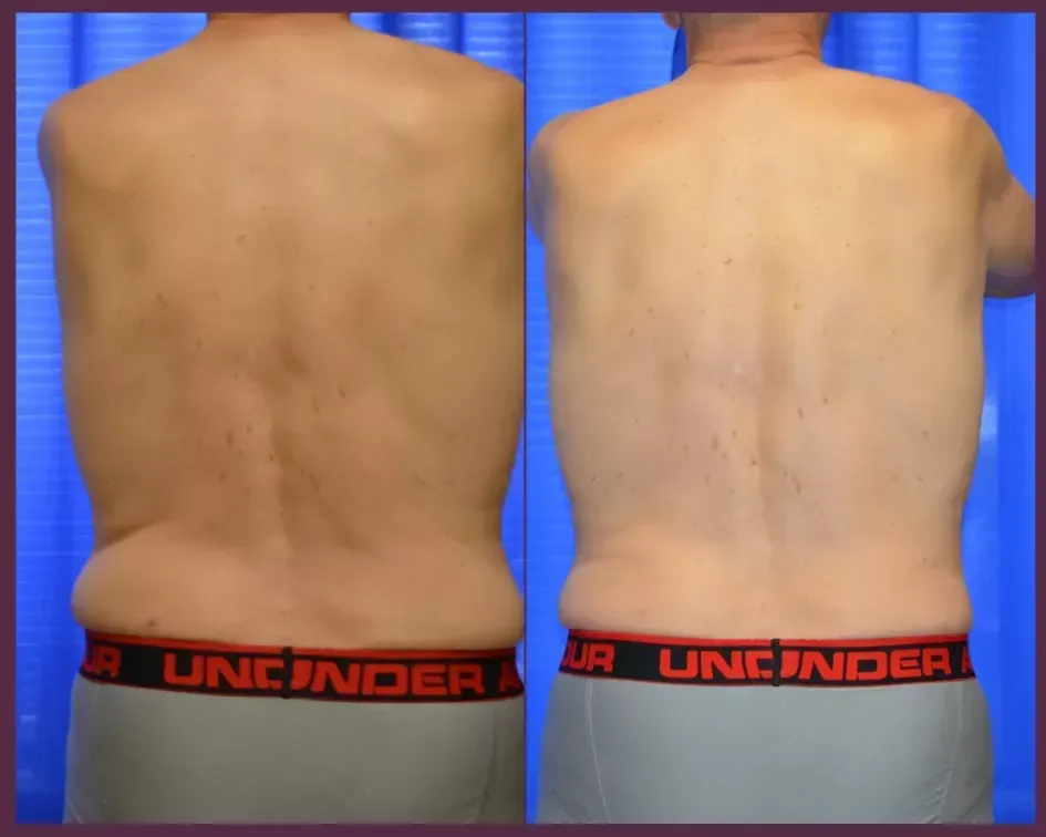 Coolsculpting For Men Before & After
