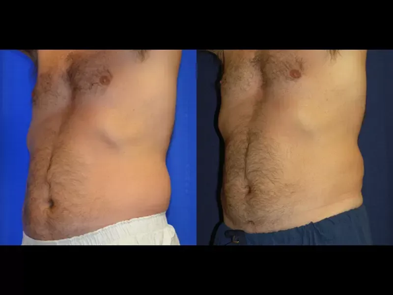 Coolsculpting For Men Before & After