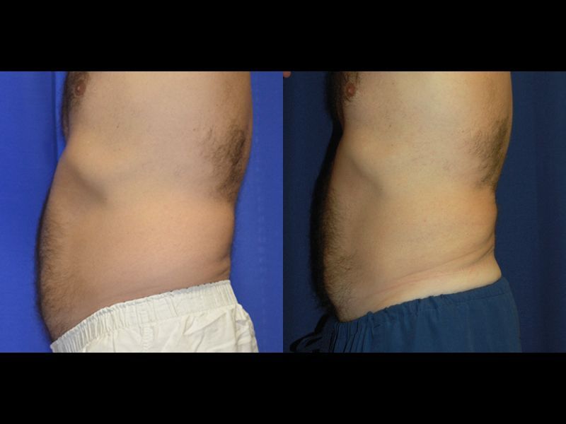 Coolsculpting For Men Before & After