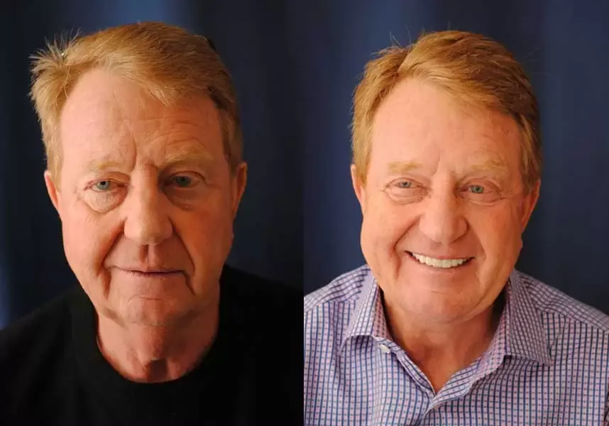 Neck Lift Before & After