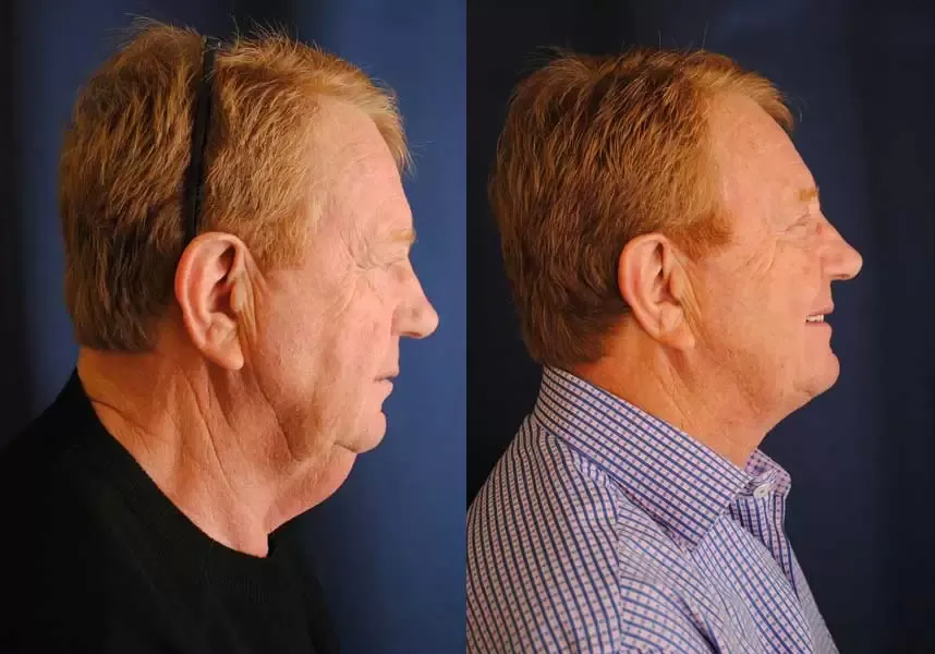 Neck Lift Before & After