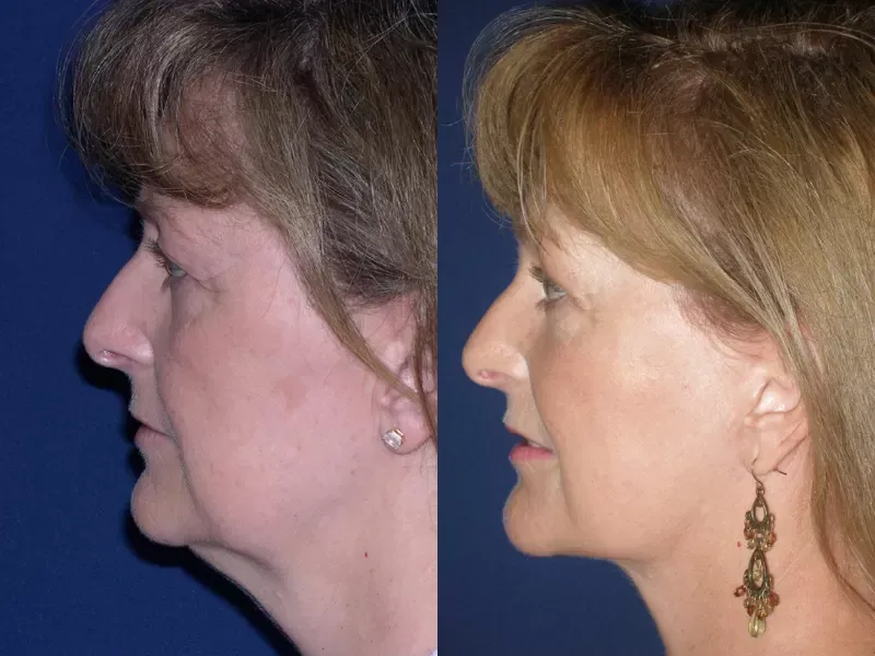 Neck Lift Before & After