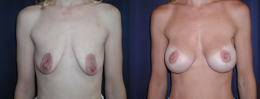 Breast Augmentation Lift Before & After