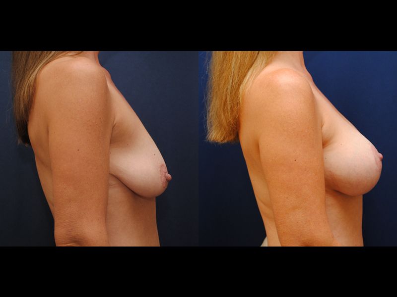 Breast Augmentation Lift Before & After
