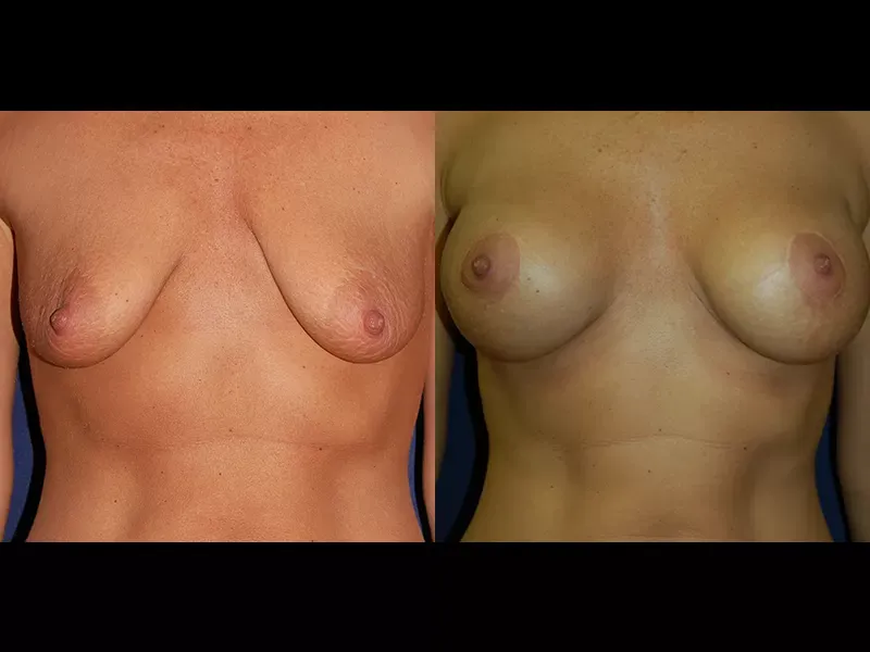 Breast Augmentation Lift Before & After