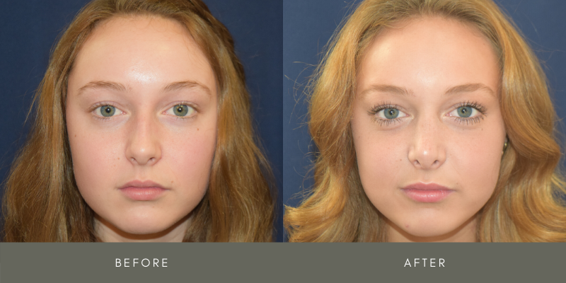 Rhinoplasty Before & After