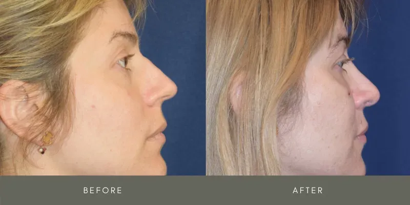 Rhinoplasty Before & After