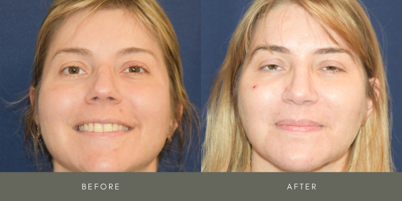 Rhinoplasty Before & After